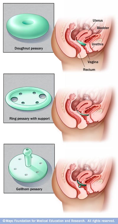Uterine Prolapse Ring Pessary Uterine Prolapse Ring Pessary